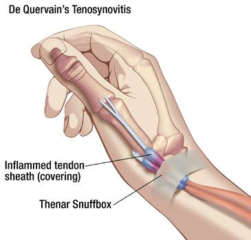 De Quervain 